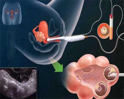 输卵管通液术后多久可以助孕：上海最好的代孕